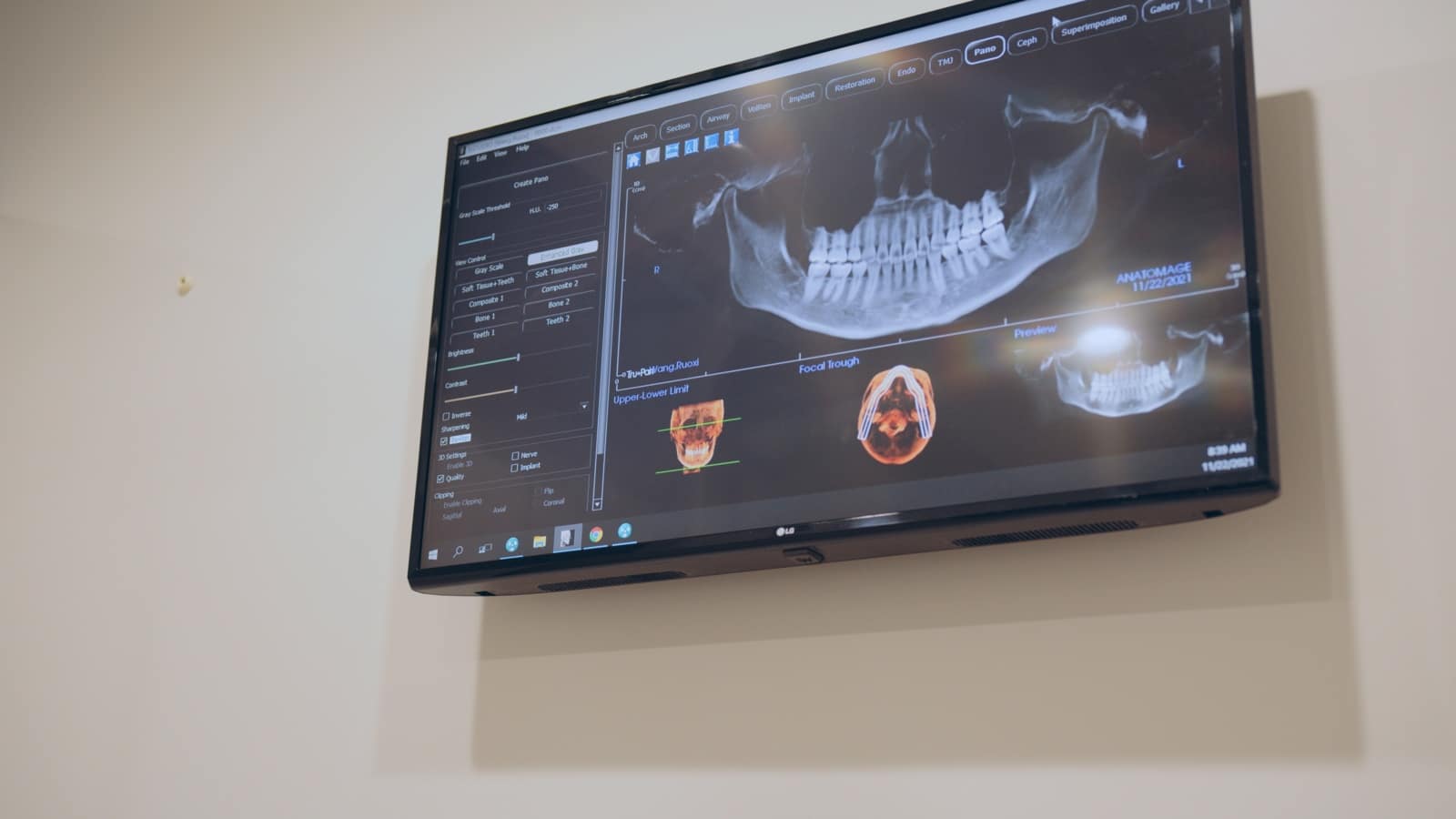 Well Closeup view of x ray on a monitor on the wall